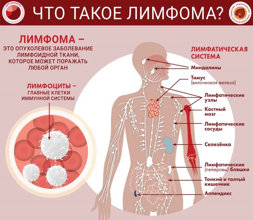 Всемирный день борьбы с лимфомами